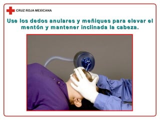 Use los dedos anulares y meñiques para elevar el mentón y mantener inclinada la cabeza. 