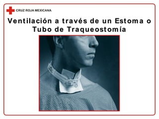 Ventilación a través de un Estoma o Tubo de Traqueostomía 