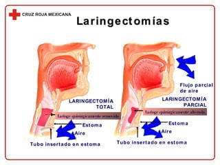 Laringectomías LARINGECTOMÍA TOTAL LARINGECTOMÍA PARCIAL Estoma Tubo insertado en estoma Aire Estoma Tubo insertado en estoma Aire Flujo parcial de aire Laringe quirúrgicamente alterada Laringe quirúrgicamente removida 