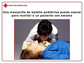 Una mascarilla de bolsillo pediátrica puede usarse para ventilar a un paciente con estoma 