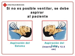 Si no es posible ventilar, se debe aspirar  al paciente Aspiración del Estoma Aspiración del Tubo (insertar 7.5 a 12.5 cm) 