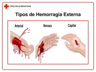 Tipos de Hemorragia Externa 