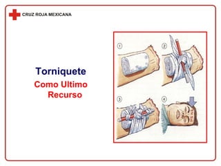 Torniquete Como Ultimo Recurso 