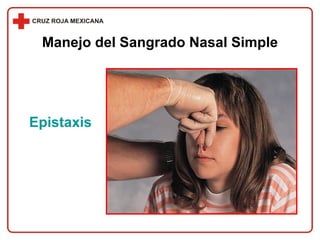 Manejo del Sangrado Nasal Simple Epistaxis 