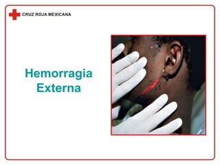 Hemorragia Externa 