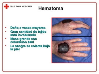 Daño a vasos mayores Gran cantidad de tejido está involucrado Masa grande con coloración azul La sangre se colecta bajo la piel Hematoma 