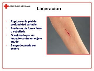 Laceración Ruptura en la piel de profundidad variable Puede ser de forma lineal o estrellada Ocasionado por un impacto contra un objeto agudo Sangrado puede ser severo 