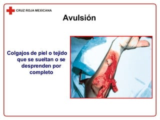Avulsión Colgajos de piel o tejido que se sueltan o se desprenden por completo 