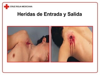 Heridas de Entrada y Salida 