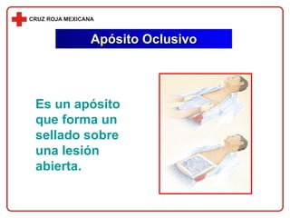 Es un apósito que forma un sellado sobre una lesión abierta. Apósito Oclusivo 