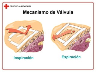 Mecanismo de Válvula Inspiración Espiración 