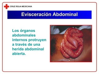 Evisceración Abdominal Los órganos abdominales internos protruyen a través de una herida abdominal abierta. 
