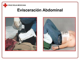 Evisceración Abdominal 