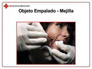 Objeto Empalado - Mejilla 