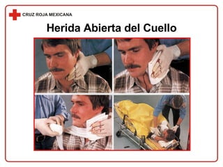 Herida Abierta del Cuello 