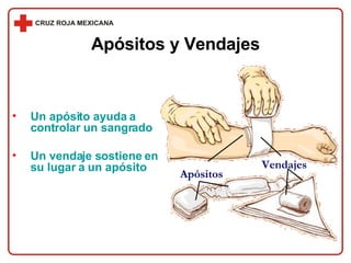Un apósito ayuda a controlar un sangrado Un vendaje sostiene en su lugar a un apósito Apósitos y Vendajes Apósitos Vendajes 
