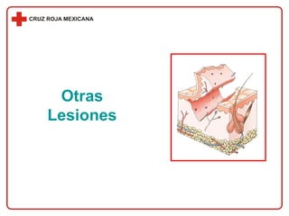 Otras Lesiones 