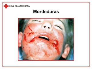 Mordeduras 