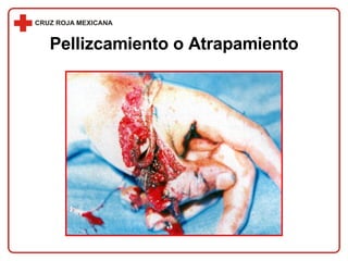 Pellizcamiento o Atrapamiento 