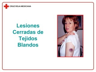 Lesiones Cerradas de Tejidos Blandos 