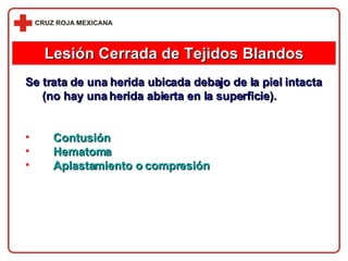 Lesión Cerrada de Tejidos Blandos Se trata de una herida ubicada debajo de la piel intacta (no hay una herida abierta en la superficie). Contusión Hematoma Aplastamiento o compresión 