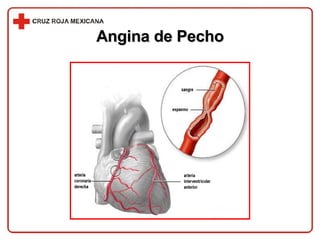 Angina de Pecho 