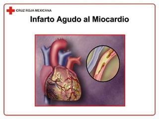 Infarto Agudo al Miocardio 