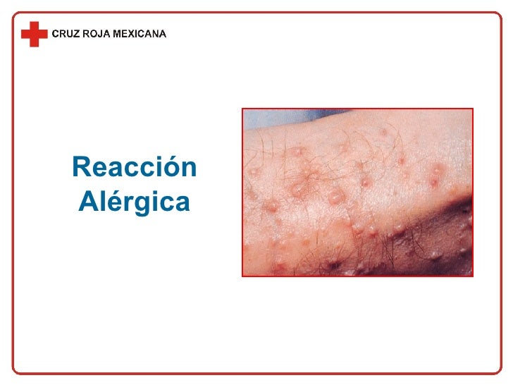 CapíTulo 30 Reacciones AléRgicas CapíTulo 30 Reacciones AléRgicas