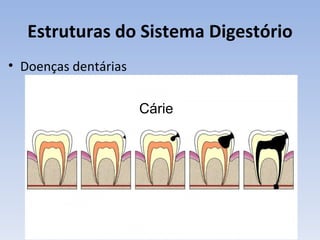 Estruturas do Sistema Digestório
• Doenças dentárias


                      Cárie
 