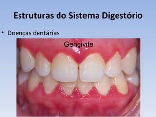 Estruturas do Sistema Digestório
• Doenças dentárias
                      Gengivite
 