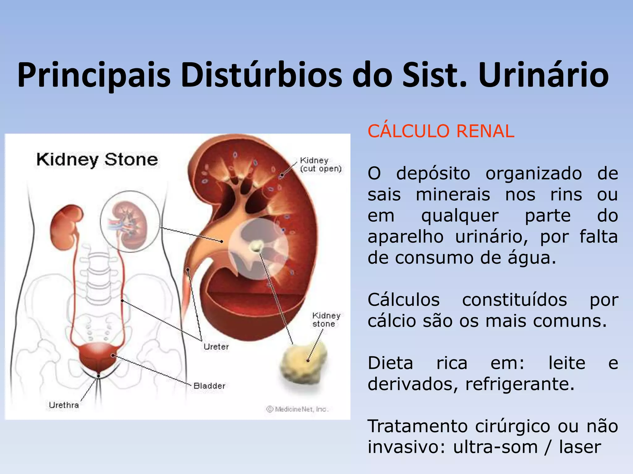 Principais Distúrbios do Sist. Urinário
                       CÁLCULO RENAL

                       O depósito organizado de
                       sais minerais nos rins ou
                       em qualquer parte do
                       aparelho urinário, por falta
                       de consumo de água.

                       Cálculos constituídos por
                       cálcio são os mais comuns.

                       Dieta rica em: leite       e
                       derivados, refrigerante.

                       Tratamento cirúrgico ou não
                       invasivo: ultra-som / laser
 