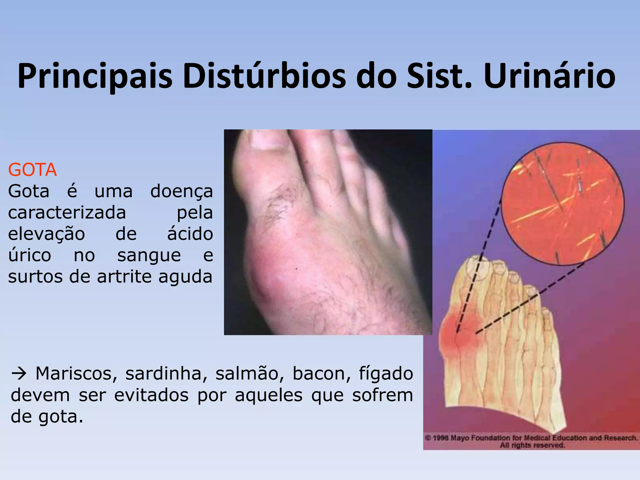 Principais Distúrbios do Sist. Urinário

GOTA
Gota é uma doença
caracterizada       pela
elevação    de     ácido
úrico no sangue e
surtos de artrite aguda




 Mariscos, sardinha, salmão, bacon, fígado
devem ser evitados por aqueles que sofrem
de gota.
 