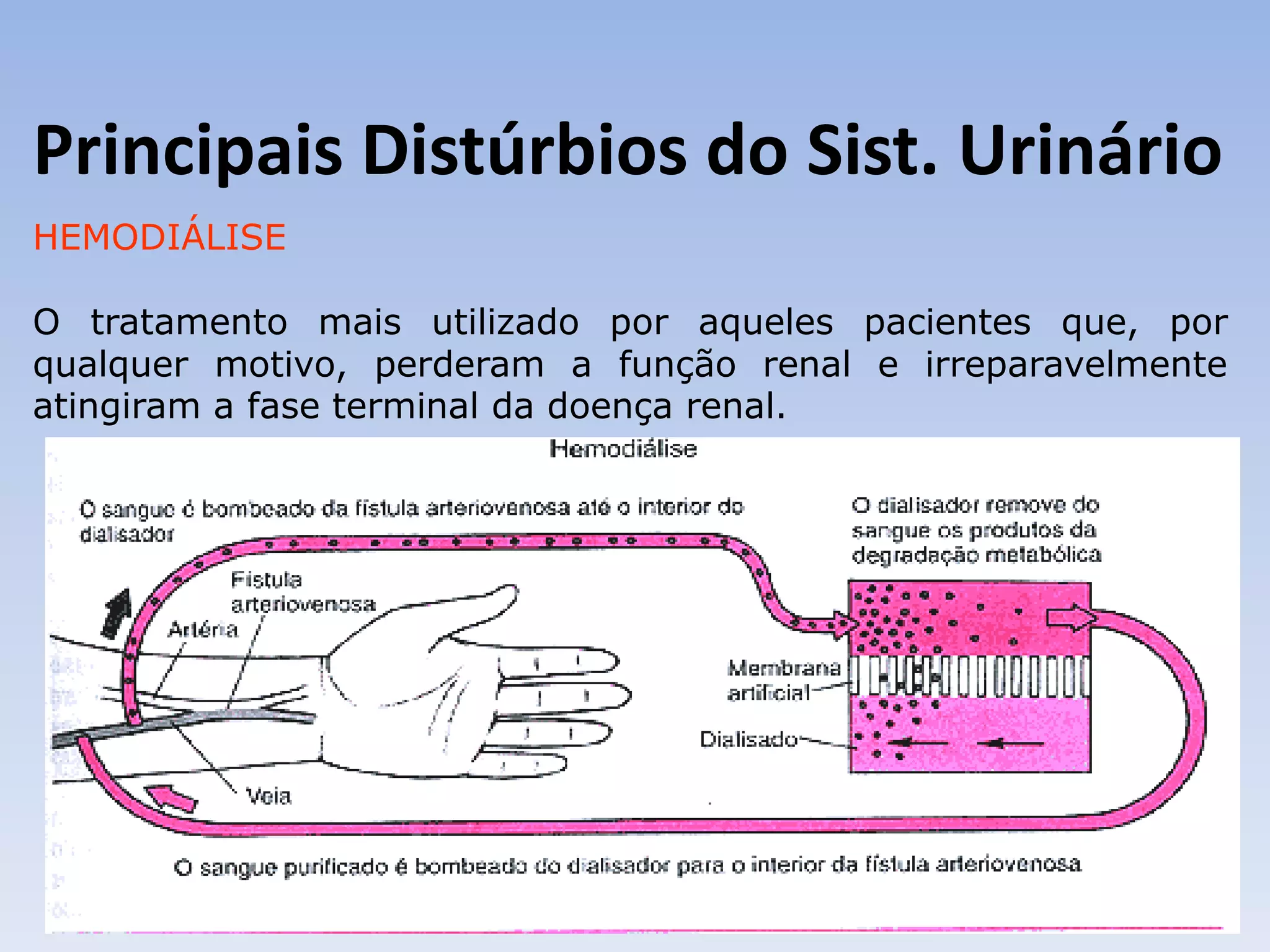Principais Distúrbios do Sist. Urinário
HEMODIÁLISE

O tratamento mais utilizado por aqueles pacientes que, por
qualquer motivo, perderam a função renal e irreparavelmente
atingiram a fase terminal da doença renal.
 