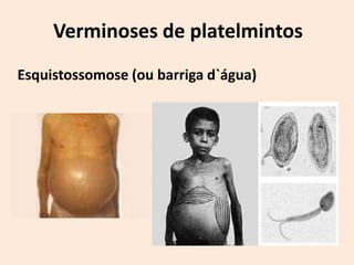 Verminoses de platelmintos
Esquistossomose (ou barriga d`água)
 