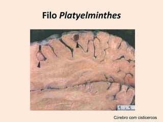Filo Platyelminthes




                 Cérebro com cisticercos
 