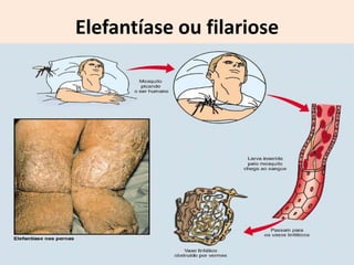Elefantíase ou filariose
 