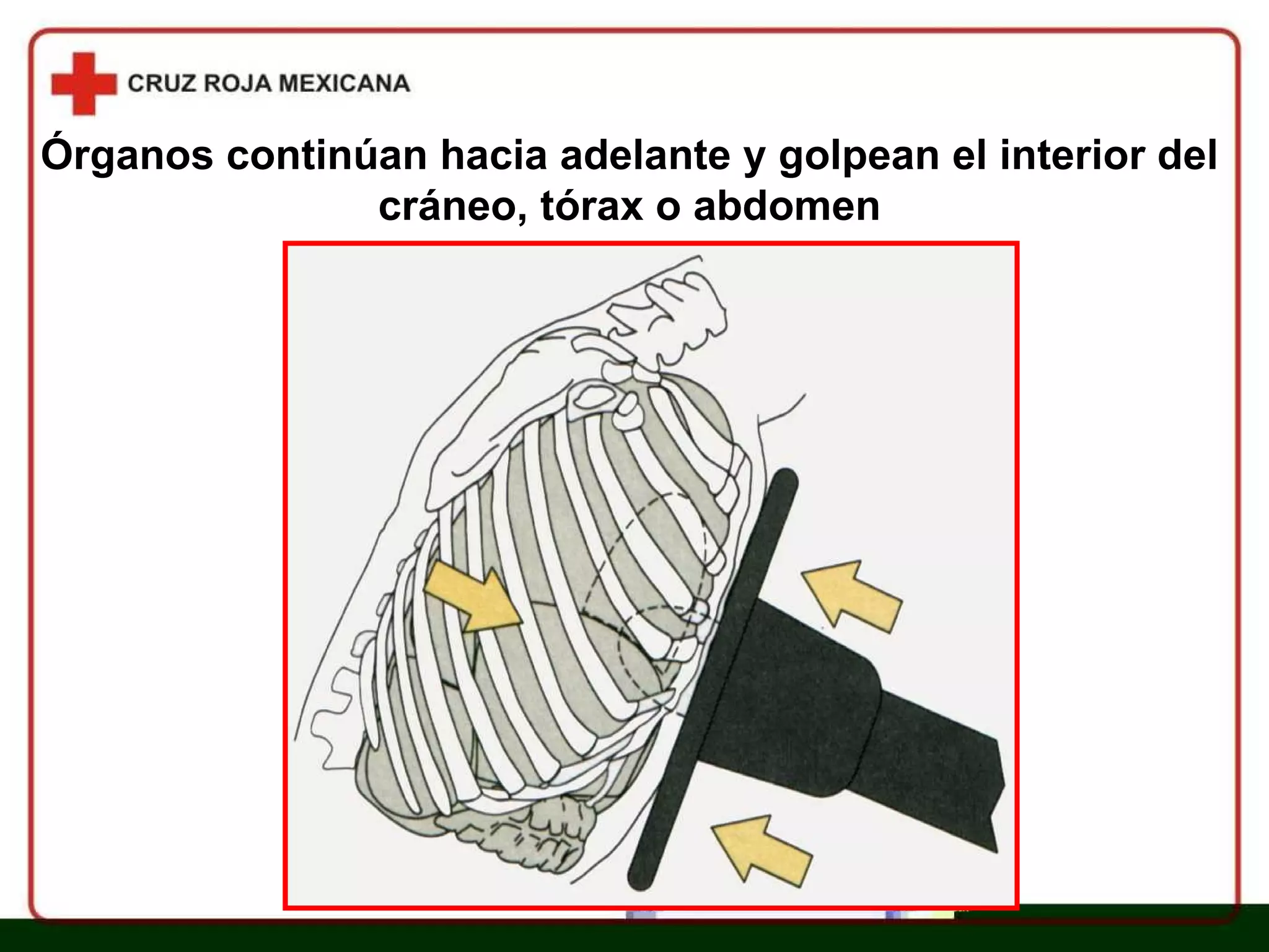 Capítulo 13 Mecanismos De Lesión | PPT