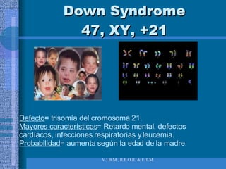 Down Syndrome 47, XY, +21 Defecto = trisomía del cromosoma 21.  Mayores características = Retardo mental, defectos cardíacos, infecciones respiratorias y leucemia. Probabilidad = aumenta según la edad de la madre. 
