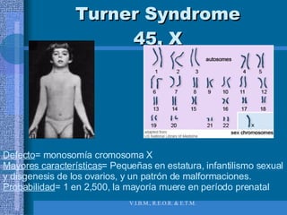 Turner Syndrome 45, X Defecto = monosomía cromosoma X Mayores características = Pequeñas en estatura, infantilismo sexual y disgenesis de los ovarios, y un patrón de malformaciones.  Probabilidad = 1 en 2,500, la mayoría muere en período prenatal 