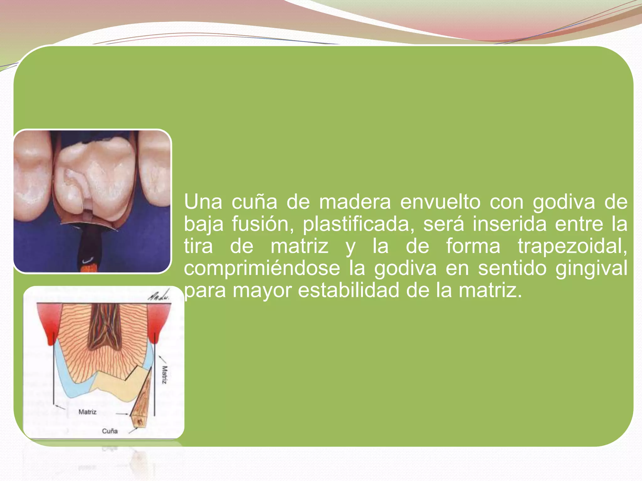 Una cuña de madera envuelto con godiva de 
baja fusión, plastificada, será inserida entre la 
tira de matriz y la de forma trapezoidal, 
comprimiéndose la godiva en sentido gingival 
para mayor estabilidad de la matriz. 
 