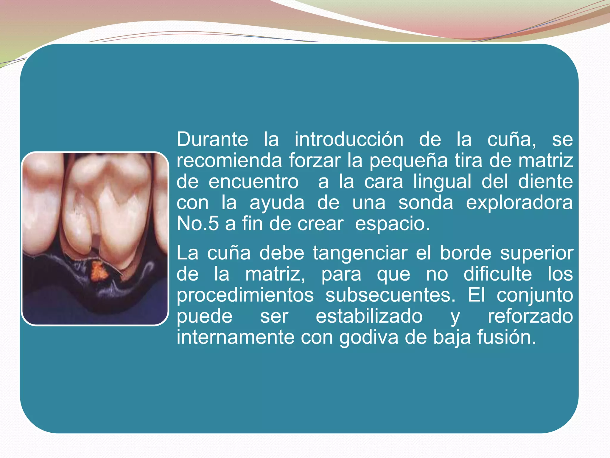 Durante la introducción de la cuña, se 
recomienda forzar la pequeña tira de matriz 
de encuentro a la cara lingual del diente 
con la ayuda de una sonda exploradora 
No.5 a fin de crear espacio. 
La cuña debe tangenciar el borde superior 
de la matriz, para que no dificulte los 
procedimientos subsecuentes. El conjunto 
puede ser estabilizado y reforzado 
internamente con godiva de baja fusión. 
 