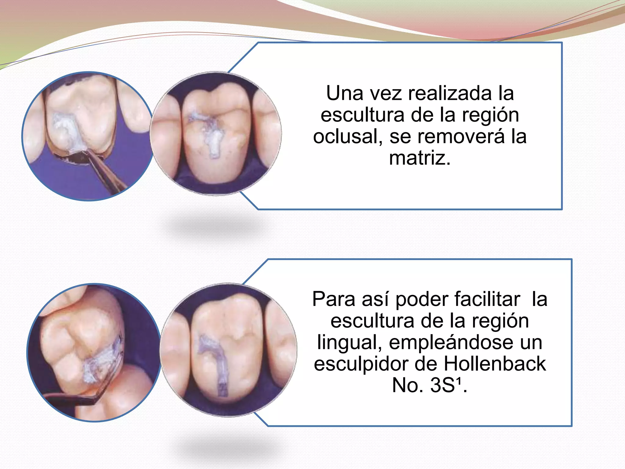 Una vez realizada la 
escultura de la región 
oclusal, se removerá la 
matriz. 
Para así poder facilitar la 
escultura de la región 
lingual, empleándose un 
esculpidor de Hollenback 
No. 3S¹. 
 