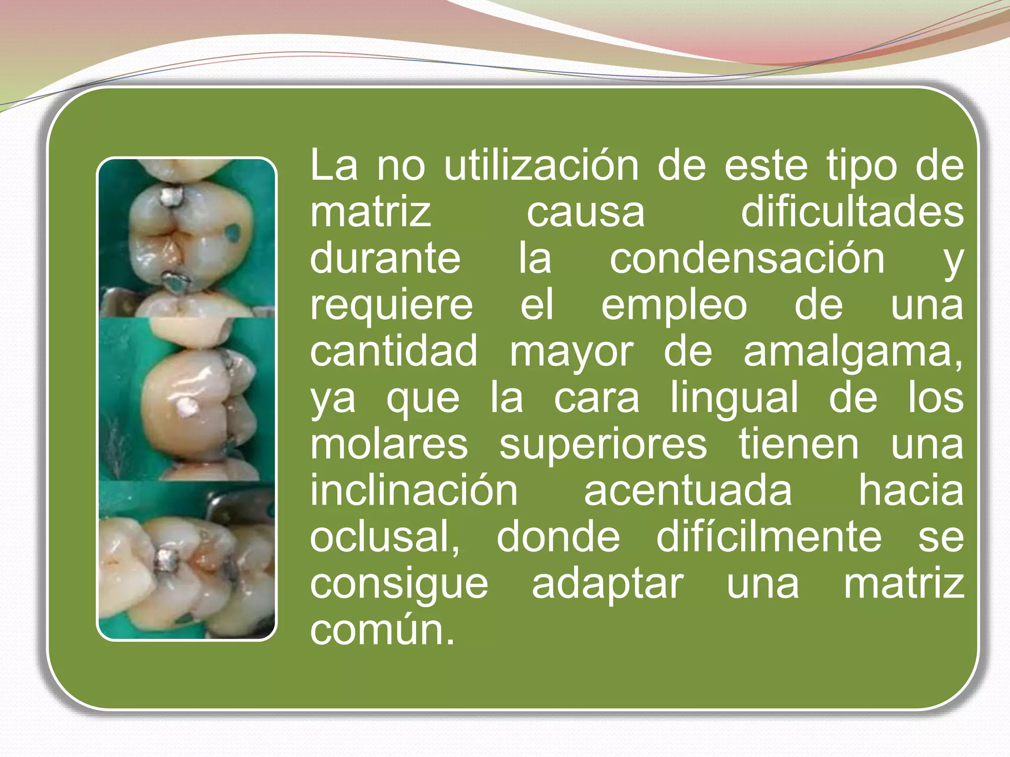 La no utilización de este tipo de 
matriz causa dificultades 
durante la condensación y 
requiere el empleo de una 
cantidad mayor de amalgama, 
ya que la cara lingual de los 
molares superiores tienen una 
inclinación acentuada hacia 
oclusal, donde difícilmente se 
consigue adaptar una matriz 
común. 
 