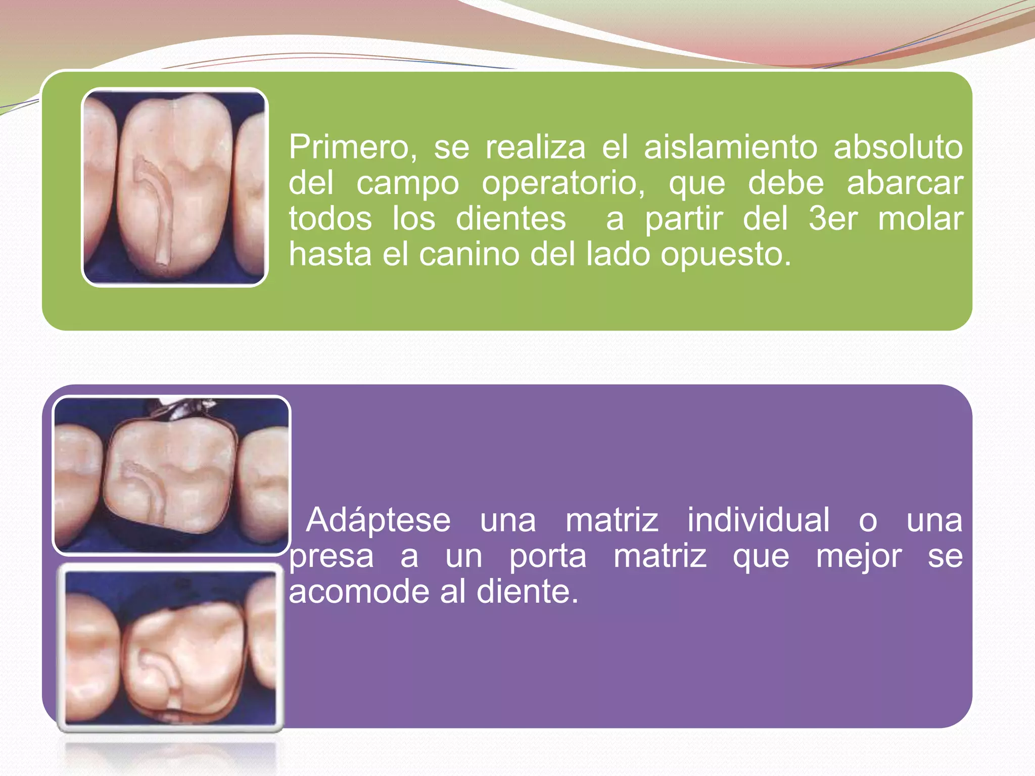 Primero, se realiza el aislamiento absoluto 
del campo operatorio, que debe abarcar 
todos los dientes a partir del 3er molar 
hasta el canino del lado opuesto. 
Adáptese una matriz individual o una 
presa a un porta matriz que mejor se 
acomode al diente. 
 