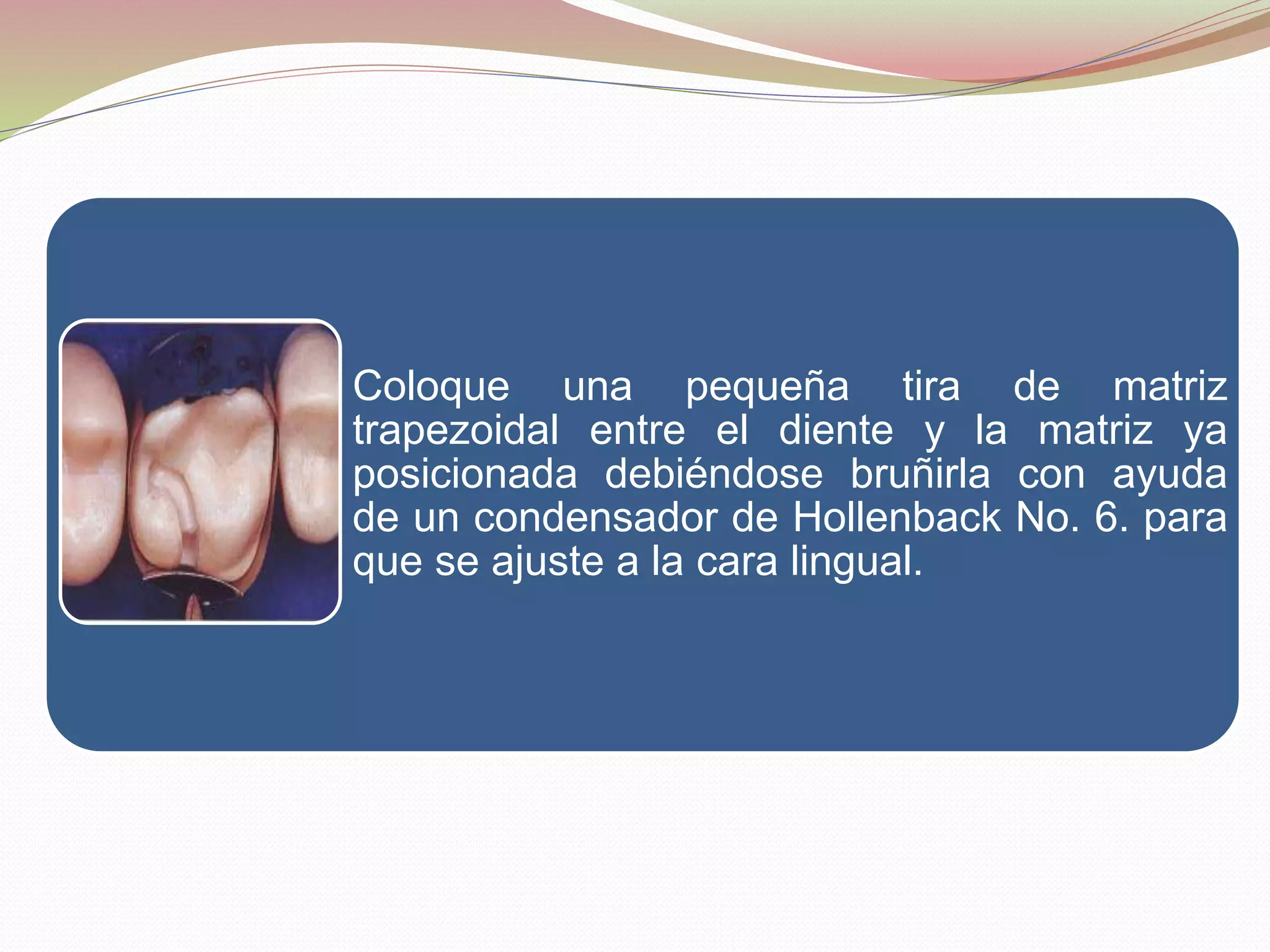 Coloque una pequeña tira de matriz 
trapezoidal entre el diente y la matriz ya 
posicionada debiéndose bruñirla con ayuda 
de un condensador de Hollenback No. 6. para 
que se ajuste a la cara lingual. 
 