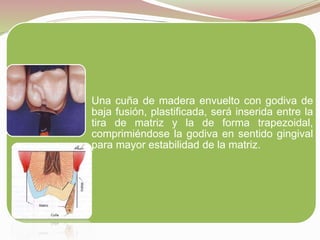 Una cuña de madera envuelto con godiva de 
baja fusión, plastificada, será inserida entre la 
tira de matriz y la de forma trapezoidal, 
comprimiéndose la godiva en sentido gingival 
para mayor estabilidad de la matriz. 
 