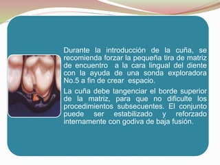 Durante la introducción de la cuña, se 
recomienda forzar la pequeña tira de matriz 
de encuentro a la cara lingual del diente 
con la ayuda de una sonda exploradora 
No.5 a fin de crear espacio. 
La cuña debe tangenciar el borde superior 
de la matriz, para que no dificulte los 
procedimientos subsecuentes. El conjunto 
puede ser estabilizado y reforzado 
internamente con godiva de baja fusión. 
 
