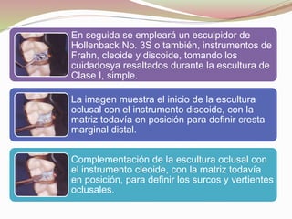 En seguida se empleará un esculpidor de 
Hollenback No. 3S o también, instrumentos de 
Frahn, cleoide y discoide, tomando los 
cuidadosya resaltados durante la escultura de 
Clase I, simple. 
La imagen muestra el inicio de la escultura 
oclusal con el instrumento discoide, con la 
matriz todavía en posición para definir cresta 
marginal distal. 
Complementación de la escultura oclusal con 
el instrumento cleoide, con la matriz todavía 
en posición, para definir los surcos y vertientes 
oclusales. 
 