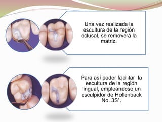 Una vez realizada la 
escultura de la región 
oclusal, se removerá la 
matriz. 
Para así poder facilitar la 
escultura de la región 
lingual, empleándose un 
esculpidor de Hollenback 
No. 3S¹. 
 