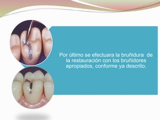 Por último se efectuara la bruñidura de 
la restauración con los bruñidores 
apropiados, conforme ya descrito. 
 